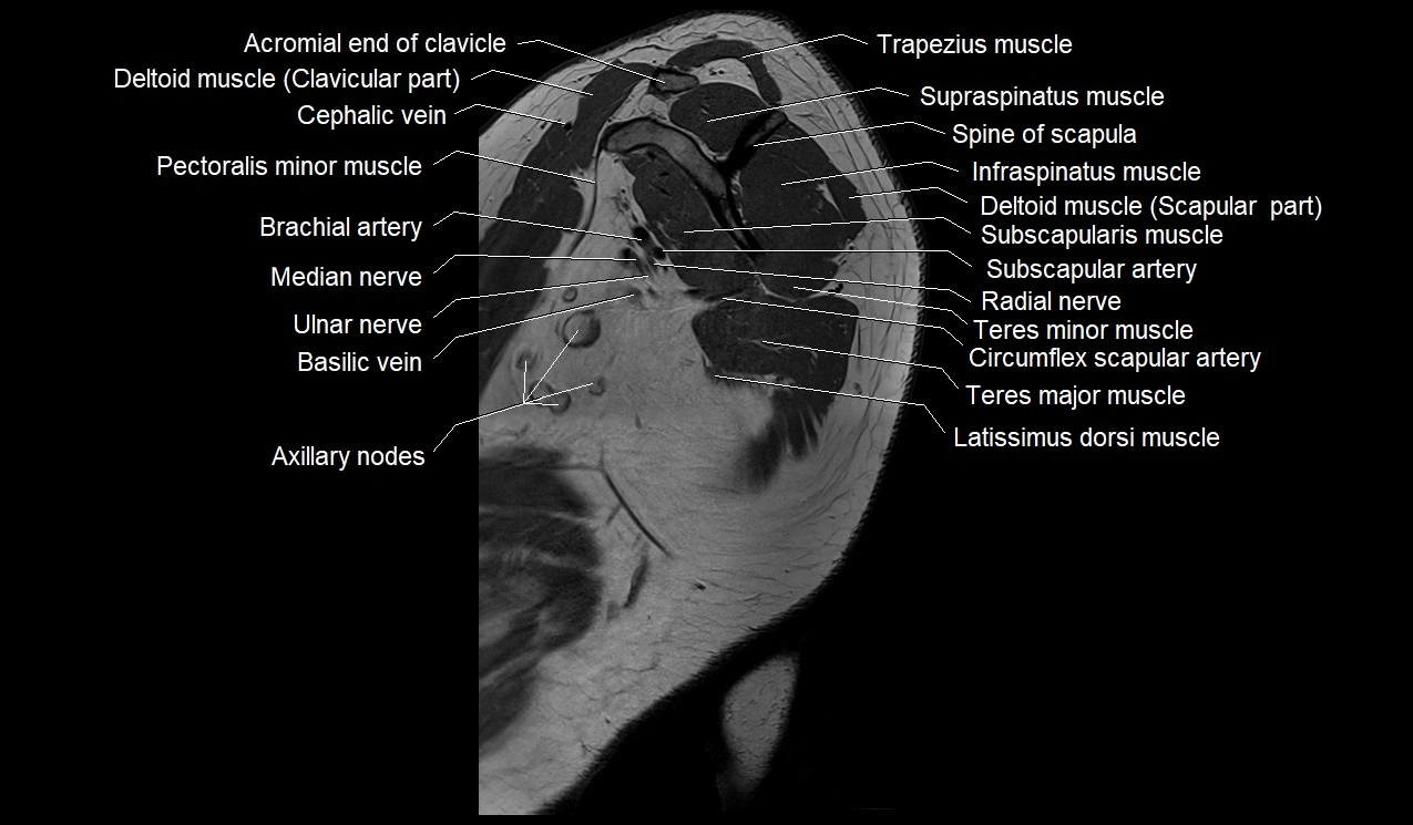 Upper arm (humerus ) saittal cross sectional anatomy 3T image 32.webp